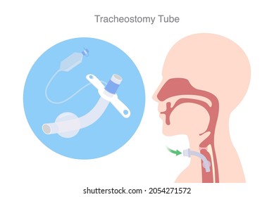 Tracheostomy tube or Trach tube is a device to help a patient who can not breathe with nose and mouth. Illustration about medical equipment and surgical.