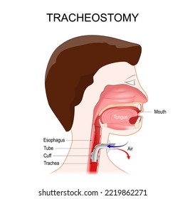 Tracheotomy. Side View Of The Neck And The Correct Placement Of A Tracheostomy Tube In The Trachea. The Stoma For A Tracheal Tube Or Tracheostomy Tube. Vector Illustration