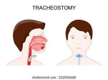 Tracheotomy. side view of the neck and placement of a tracheostomy tube in the trachea. external view of a patient with a tracheostomy in windpipe. Vector illustration