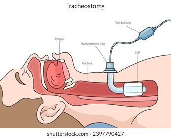 Tracheotomy tube structure vertebral column diagram hand drawn schematic vector illustration. Medical science educational illustration