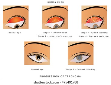 目のトラホーム トラコーマの進行 クラミジア トラコーマに起因する目の感染症 トラコーマは目に影響を及ぼす細菌感染症です のベクター画像素材 ロイヤリティフリー