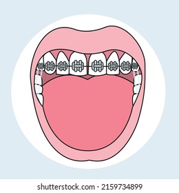 Traditional Metal Braces Orthodontist vector illustrator