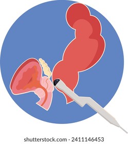 trans rectal ultrasound for investigating the prostate