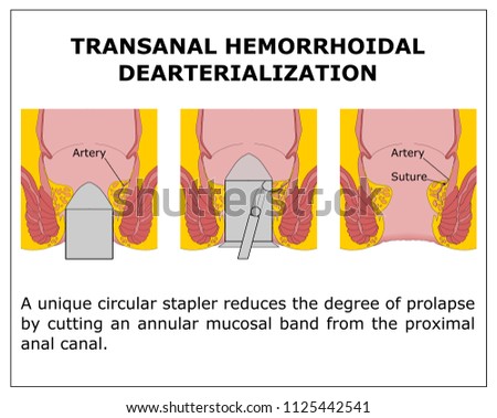 TRANSANAL HEMORRHOIDAL DEARTERIALIZATION,color vector illustration