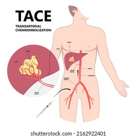 Transarterial chemoembolization or TACE treat embolization hepatic radio frequency A B C biliary atresia infusion