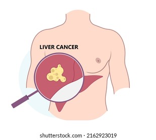 Transarterial chemoembolization or TACE treat embolization hepatic radio frequency A B C biliary atresia infusion