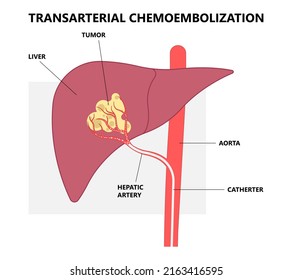 Transarterial Chemoembolization Or TACE Treat Embolization Hepatic Radio Frequency A B C Biliary Atresia Infusion