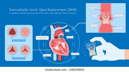 Transcatheter aortic valve replacement implantation TAVR TAVI minimally invasive surgery for treatment Aortic stenosis AS blocked 