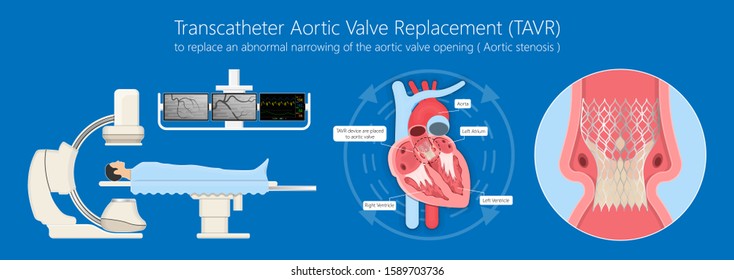 Transcatheter aortic valve replacement implantation TAVR TAVI minimally invasive surgery for treatment Aortic stenosis AS blocked 