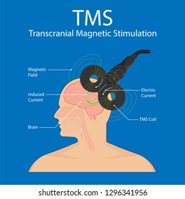 Transcranial magnetic stimulation TMS non invasive field obsessive compulsive disorder PTSD treat