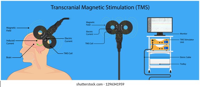 Transcranial Magnetic Stimulation Tms Non Invasive Stock Vector Royalty Free 1296341959 0975