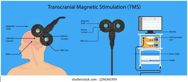 Transcranial Magnetic Stimulation Tms Non Invasive Stock Vector ...