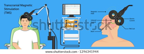 Transcranial Magnetic Stimulation Tms Non Invasive Stock Vector