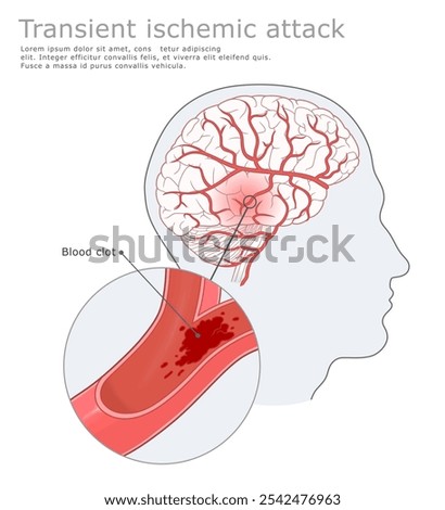 Transient ischemic attack medical illustration. Human brain and Transient ischemic attack. Vector medical illustration.