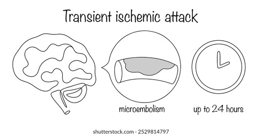 Ataque isquémico transitorio. Una disfunción especialmente aguda de la circulación sanguínea en el cerebro, que, según los síntomas, no dura más de 24 horas. Vector blanco y negro.