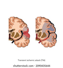 Transient Ischemic Attack TIA Vektor