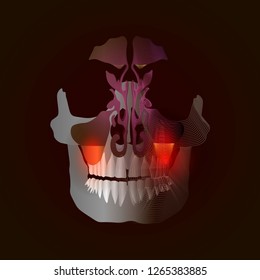 The transition from a real image to a linear x-ray effect with a point of pain and inflammation. Odontogenic sinusitis. Inflammation of the maxillary sinuses due to a disease of the roots of the tooth