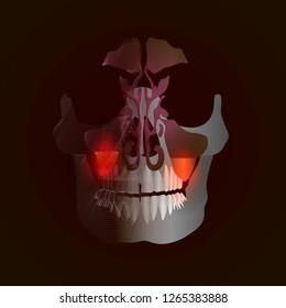 The transition from a real image to a spot X-ray effect with a point of pain and inflammation. Odontogenic sinusitis. Inflammation of the maxillary sinuses due to a disease of the roots of the tooth