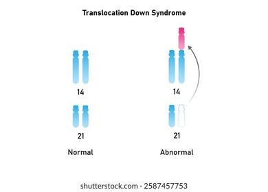 Translocation Down Syndrome Science Design. Vector Illustration.