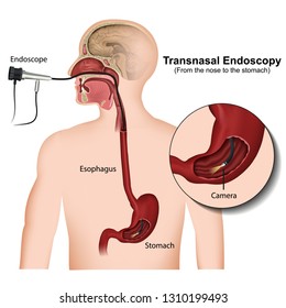 Transnasal Endoscopy Medical Vector Illustration On White Background