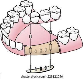 Transosteal implant: the implant is placed under the jaw bone with posts passing throught the bone. The prosthesis is attached to these posts. 