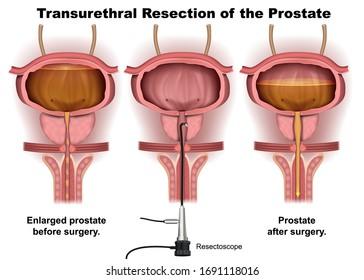 Transurethral Resection 3d illustration medical vector infographic with english description