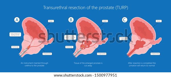 turp resección transuretral de la próstata