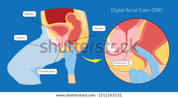 Transurethral Resection Prostate Stricture Urine Bladder庫存向量圖 免版稅 1511163131