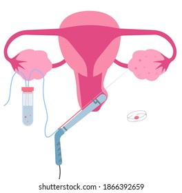 Transvaginal Oocyte Retrieval, One Of In Vitro Fertilization Or IVF Procedure.