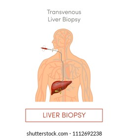 Transvenous liver biopsy, flat vector illustration