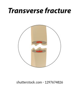 Transverse bone fracture. Infographics. Vector illustration on a lined background.