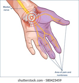 transverse carpal ligament compressed median nerve hand
