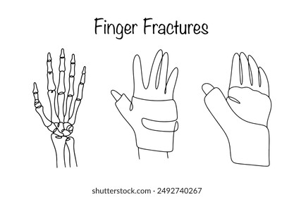 Traumatische Verletzung des Knochengewebes der Fingerphalanx. Knochen der Hand mit einer Fraktur des Daumens und der Hand in einem Gips. Vektorillustration der schwarzen Linie.