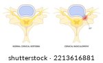 traumatic Spinal cord injury with painful pinched nerves Tingling Numbness hand thoracic neck root outlet pain damage spine canal syndrome degeneration Herniation bone disk spurs