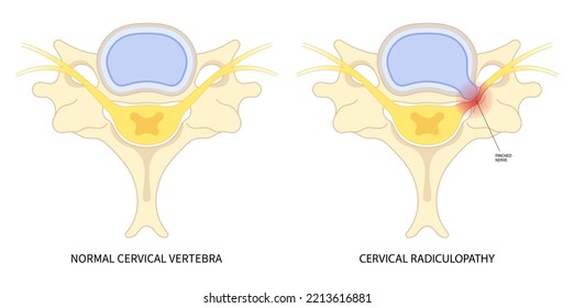 Traumatic Spinal Cord Injury With Painful Pinched Nerves Tingling Numbness Hand Thoracic Neck Root Outlet Pain Damage Spine Canal Syndrome Degeneration Herniation Bone Disk Spurs