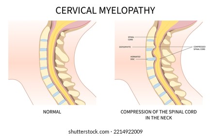 Normale Nackenanatomie im Vergleich zu einer hernisierten Gebärmutterhalskrankheit in der Medizin