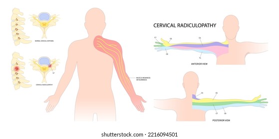 traumatic Spinal cord injury with painful pinched nerves Tingling Numbness hand thoracic neck root outlet pain damage spine canal syndrome degeneration Herniation bone disk spurs