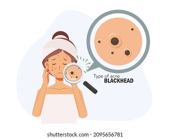 treat acne,skin problem,pimple.woman face.Type of acne blackhead.Flat vector 2d cartoon character illustration. Before, after