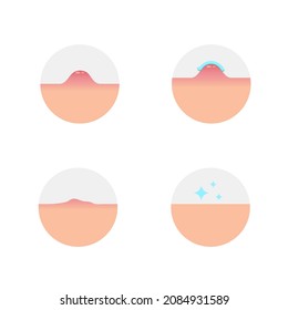 Treating inflammation. An abscess, a lump on the skin. Stages of elimination of inflammation after application of an anti-inflammatory agent. Vector illustration, flat minimal cartoon color design.
