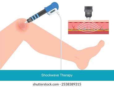 Tratamiento de los músculos de la pierna sobrecargados con terapia de ondas de choque extracorpóreas. Promueve el alivio del dolor, la recuperación muscular y la salud de la columna vertebral. (ESWT para abreviar) Atención médica, Ilustración vectorial.