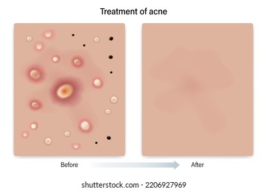 Treatment of acne. Skin before and after treatment. Blackheads, Whiteheads, Papules, Pustules, Nodules and Cysts. Vector for advertising about beauty and medical treatment.