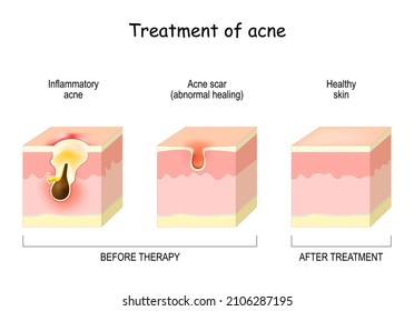 Treatment of acne. Skin layers Before and after therapy. Inflammatory acne, scar or abnormal healing and healthy skin. vector illustration