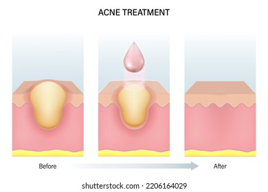 Treatment of acne. Skin layers before, during and after treatment. Acne skin and healthy skin.