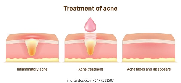 Treatment of acne. Skin layers before, during and after treatment. Acne skin and healthy skin. Treating acne with acne serum.