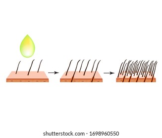 Treatment of alopecia. Bald spot, baldness, Alopecia mesotherapy. Infographics. Vector illustration on isolated background.