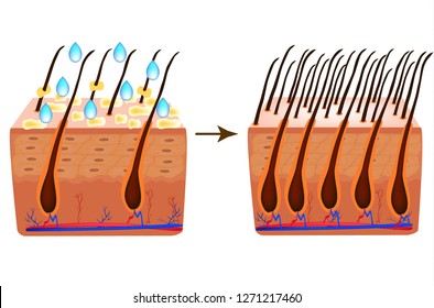 Treatment of alopecia. Vitamins hair. Biotin. Seborrhea skin and hair. Dandruff, seborrheic dermatitis. Baldness, hair growth, baldness. Anatomical structure. Infographics. Vector illustration.