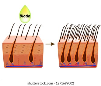 Treatment of alopecia. Vitamins hair. Biotin. Seborrhea skin and hair. Dandruff, seborrheic dermatitis. Baldness, hair growth, baldness. Anatomical structure. Infographics. Vector illustration.