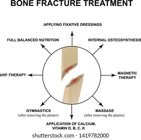 Treatment of bone fractures. Bone fracture with displacement. Infographics. Vector illustration on isolated background.