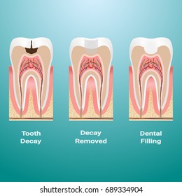 Treatment Of Caries. Dental Filling. Dental Caries Detailed Isolated On A Background. Vector Illustration. Stomatology. Teeth And Tooth Concept Of Dental