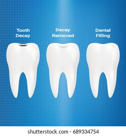 Treatment Of Caries. Dental Filling Isolated On A Background. Vector Illustration. Stomatology. Teeth And Tooth Concept Of Dental